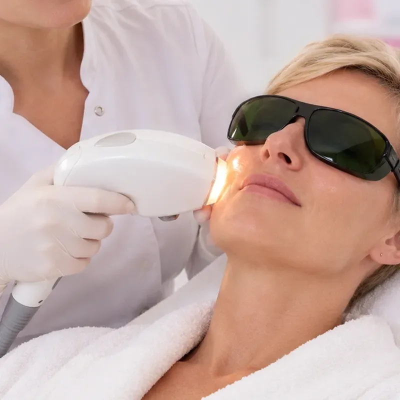 Photorajeunissement à la lumière pulsée (IPL) sur le visage — Centre Esthétique EstheMed à Nice