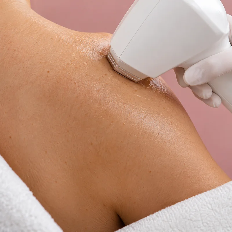 Épilation laser du dos — Centre Esthétique EstheMed à Nice
